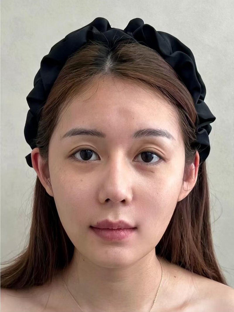 全面解析双眼皮手术：为美丽加分